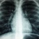 Radiografia de tórax mostra pulmões, costelas e coração, em imagem ilustrativa sobre adenocarcinoma pulmonar