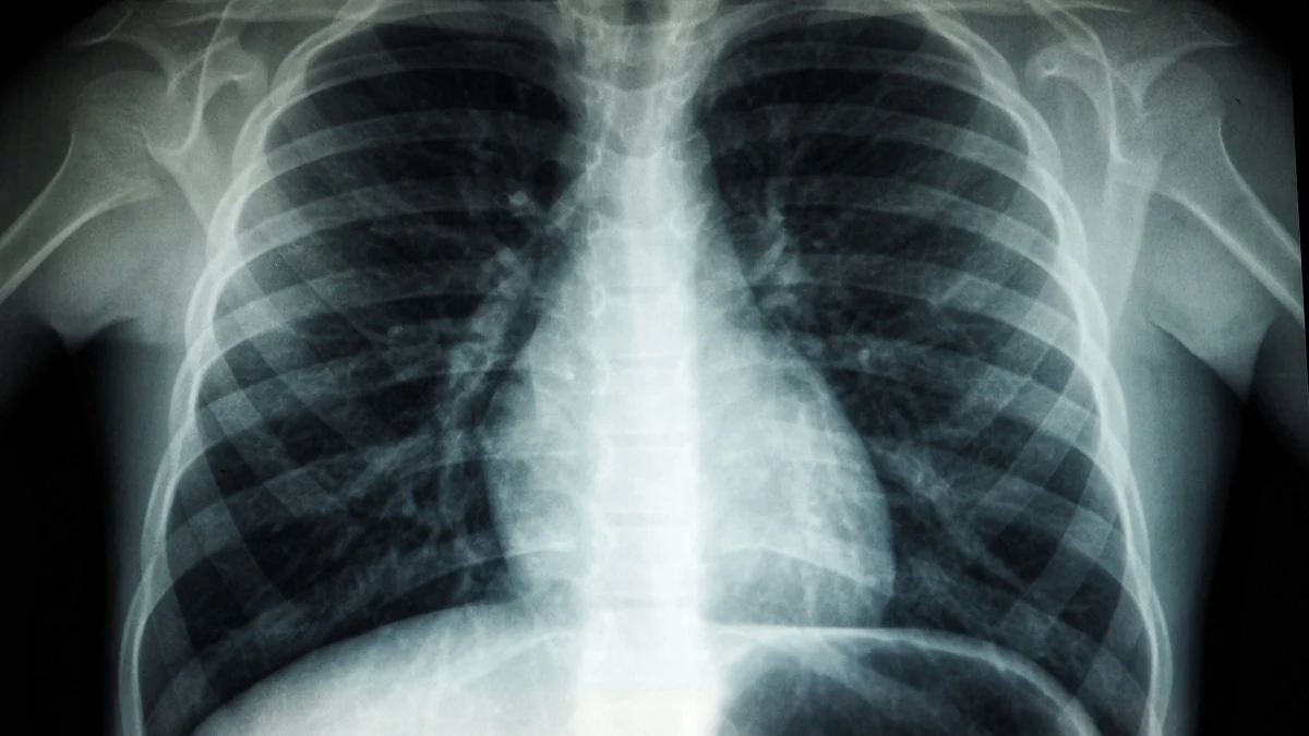 Radiografia de tórax mostra pulmões, costelas e coração, em imagem ilustrativa sobre adenocarcinoma pulmonar